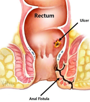 Anal Fistula Treatment by Dr. Arun Prasad
